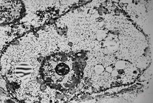 M,1y. | glycogenosis type I.(glycogen dissolved due to UA blockstaining)